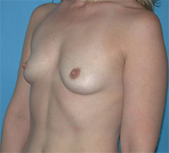 Before-Breast Implants