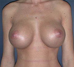 After-Breast Implants