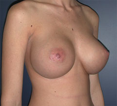 After-Breast Implants