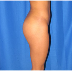 After-Buttock Implants