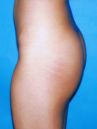 After-Buttock Implants