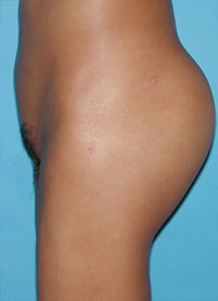 After-Buttock Implants