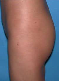 Before-Buttock Implants