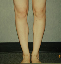 After-Calf Implants