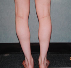 After-Calf Implants