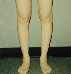 Before-Calf Implants