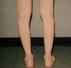 Before-Calf Implants