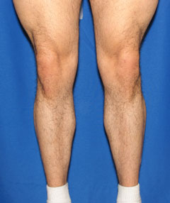 Before-Calf Implants