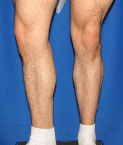 Before-Calf Implants