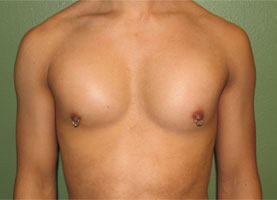 After-Pec Implants