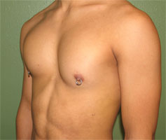 After-Pec Implants