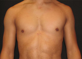 Before-Pec Implants