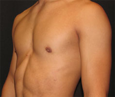 Before-Pec Implants