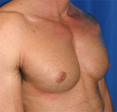 After-Pec Implants