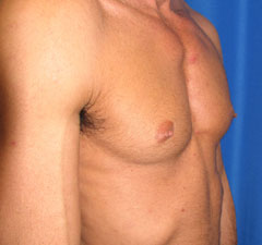 Before-Pec Implants